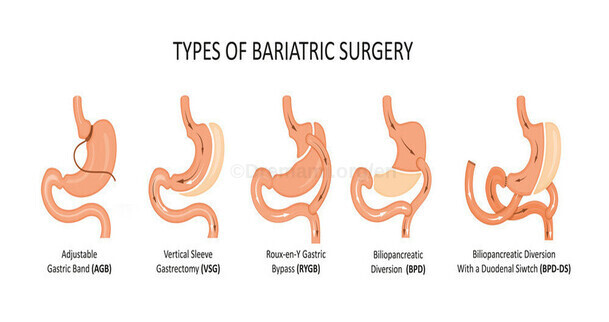 sleeve gastrectomy andother bariatric surgeries in Iran