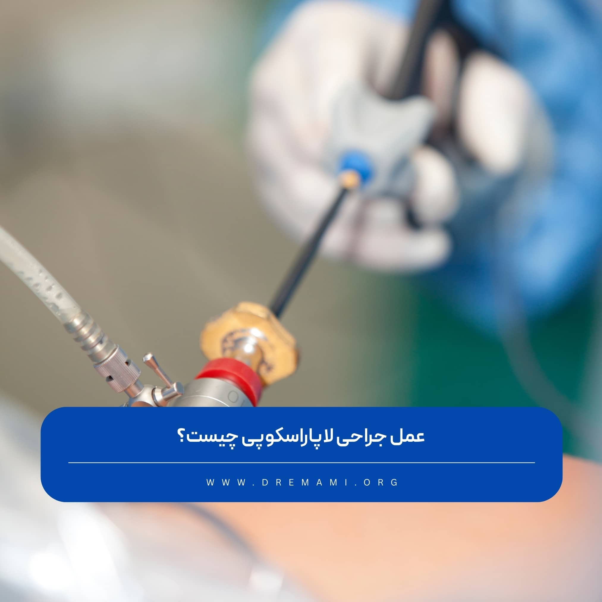 عمل لاپاراسکوپی