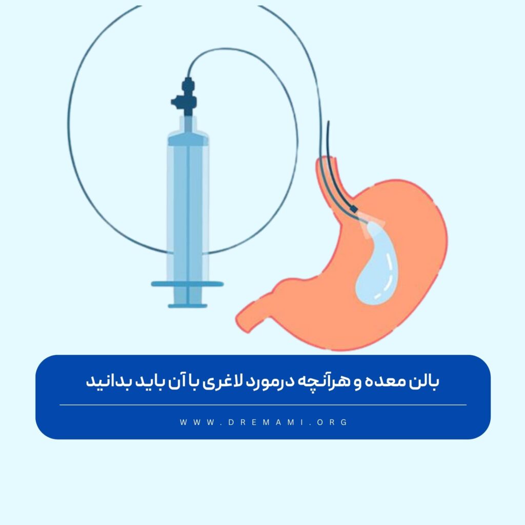 همه چیز درباره بالن معده