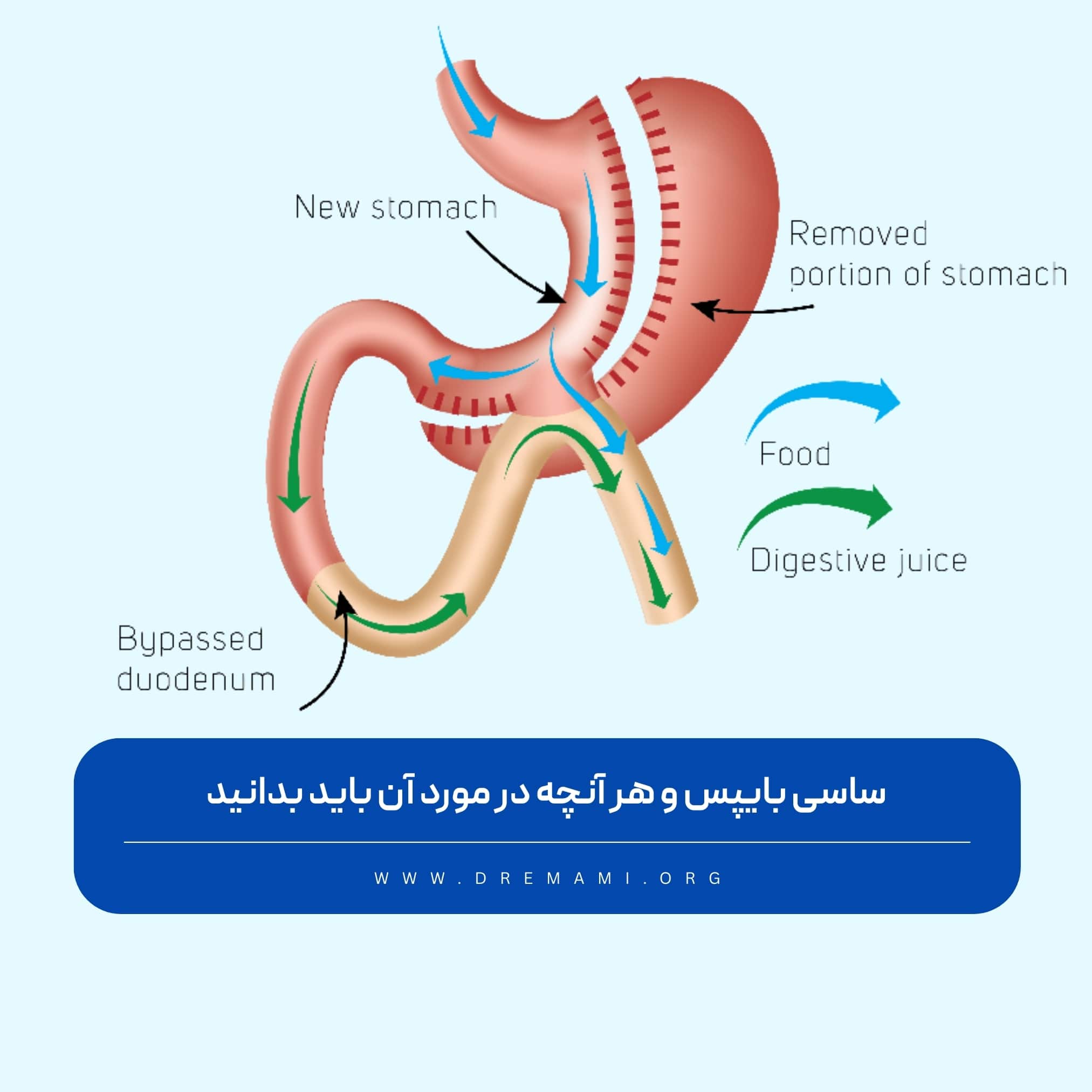 ساسی بای پس چه عملی است ؟