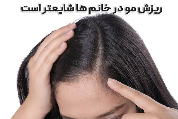 ریزش مو بعد از اسلیو معده در خانم ها شایعتر است