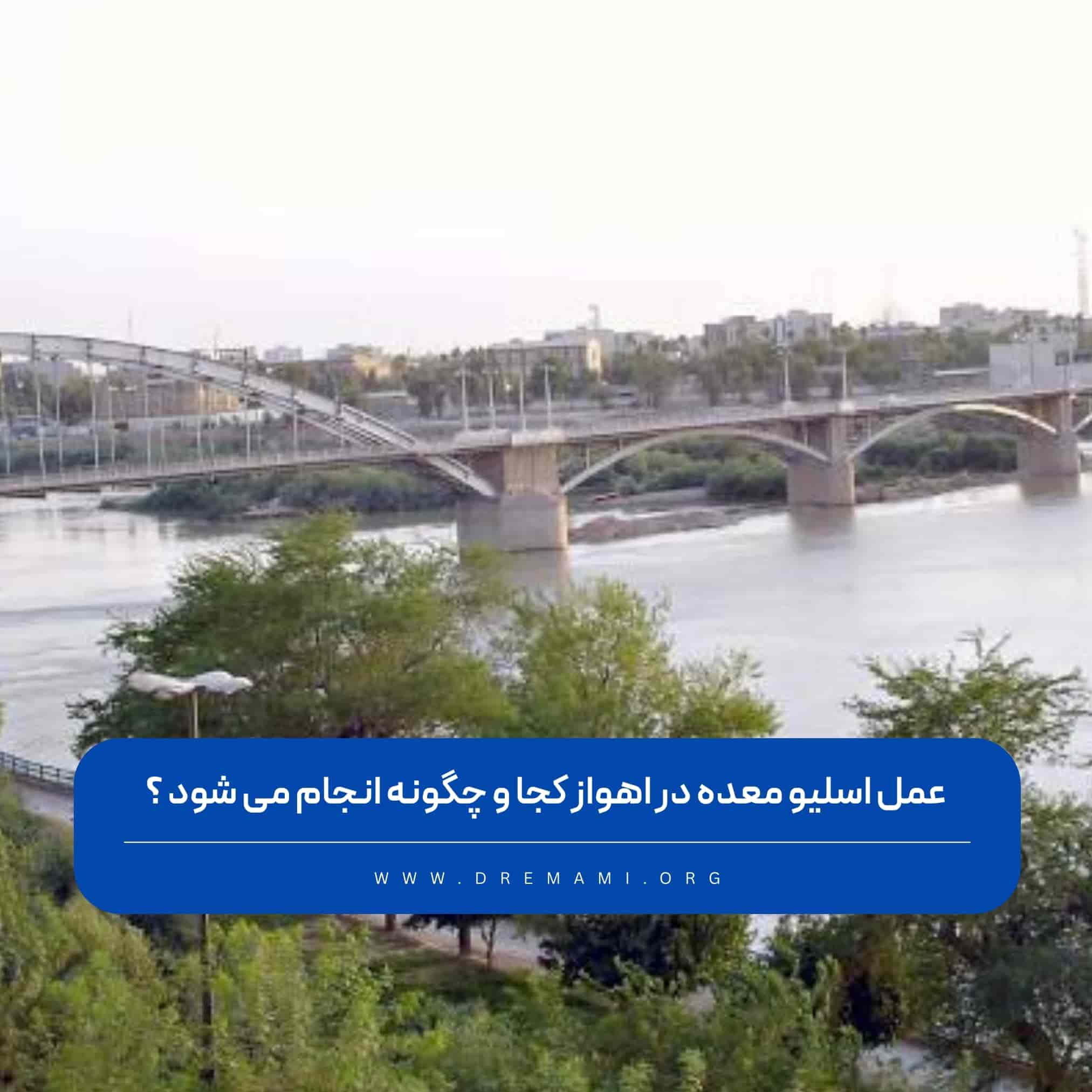 عمل اسلیو معده در اهواز