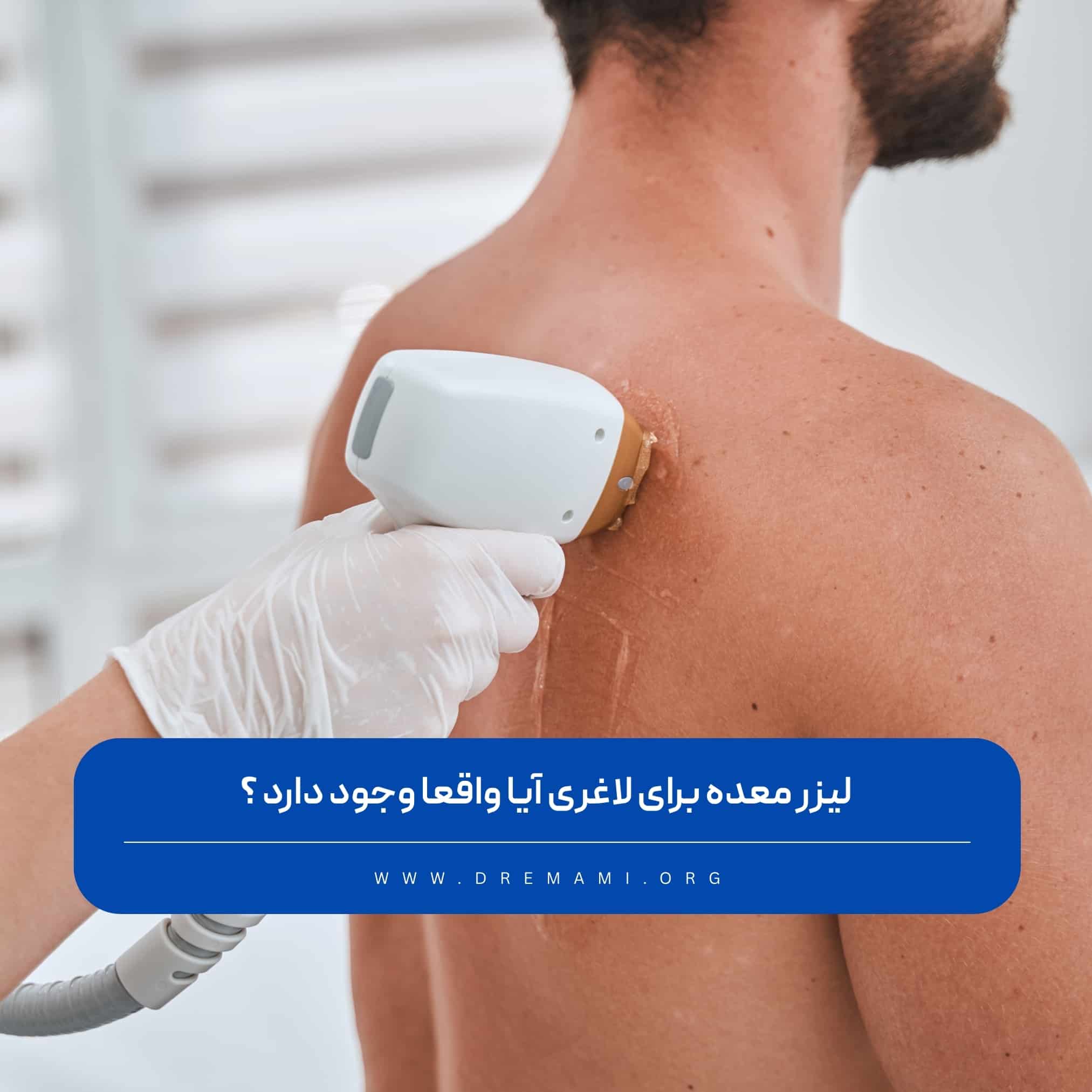لیزر معده برای لاغری