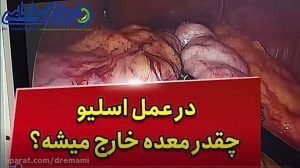 تصویر شاخص فیلم واقعی عمل اسلیو معده