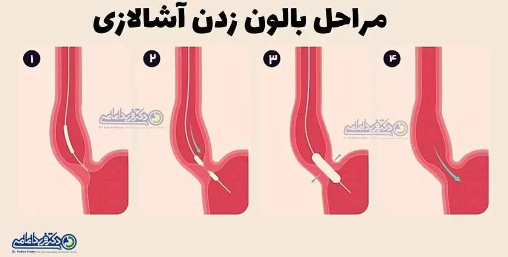 بالون زدن