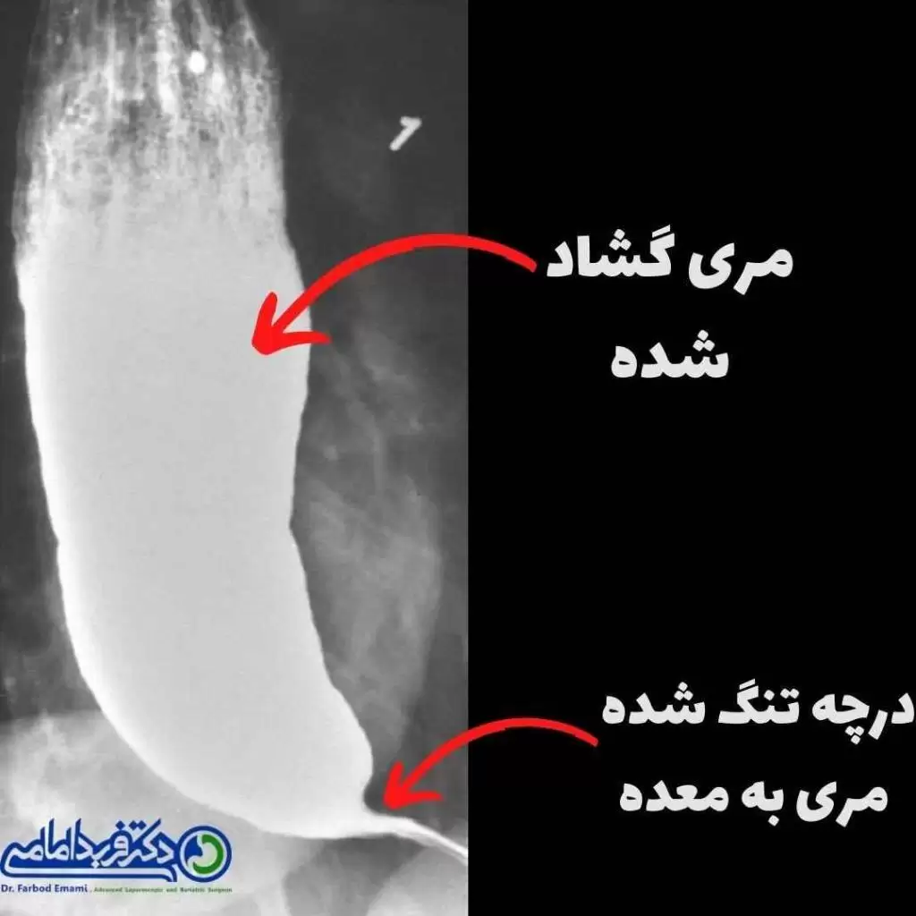 تصویر رادیولوژی آشالازی