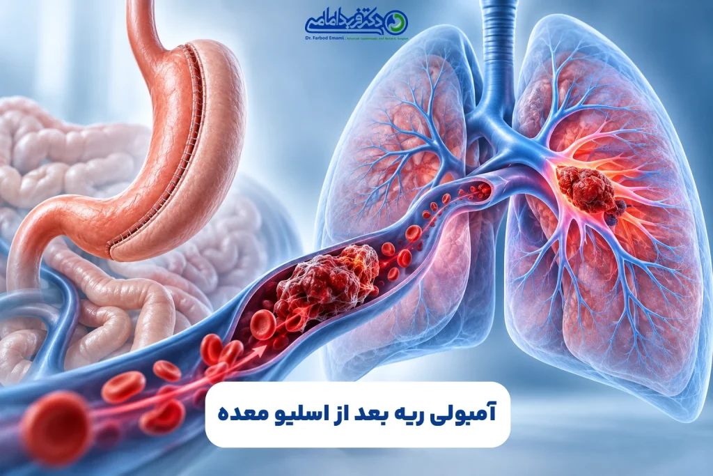 آمبولی ریه بعد از اسلیو معده