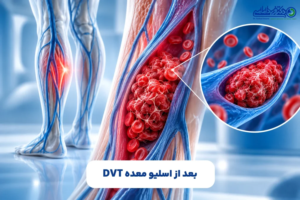 DVT بعد از اسلیو معده