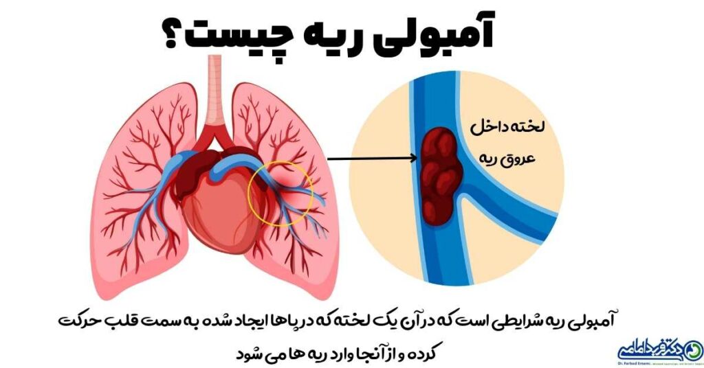 آمبولی ریه چیست