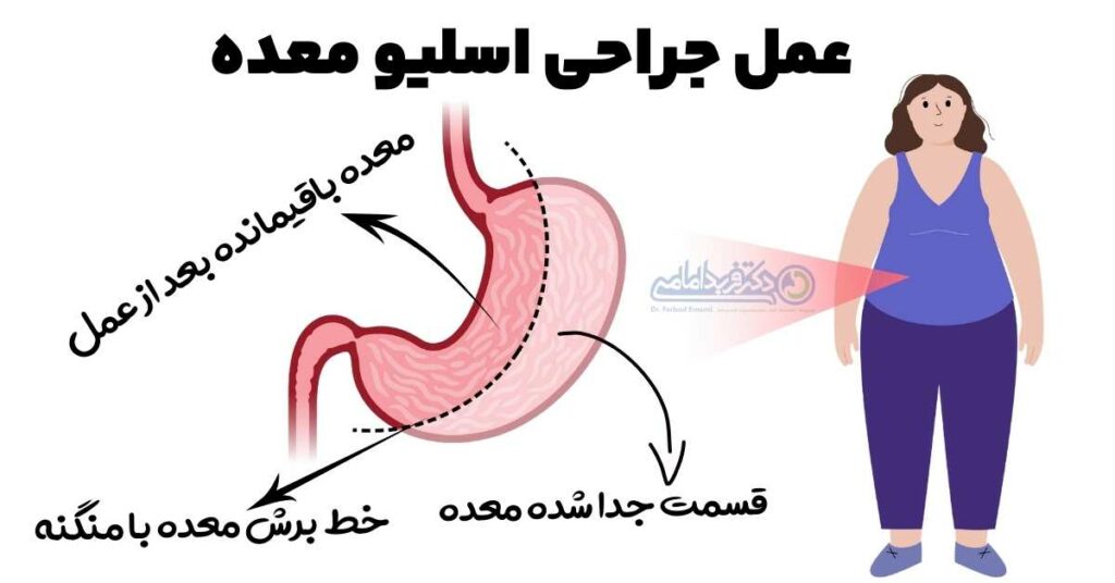عمل جراحی اسلیو معده