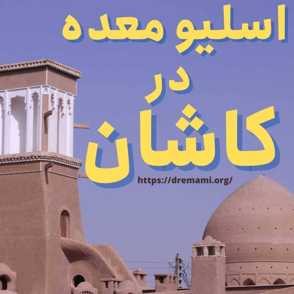 اسلیو معده در کاشان