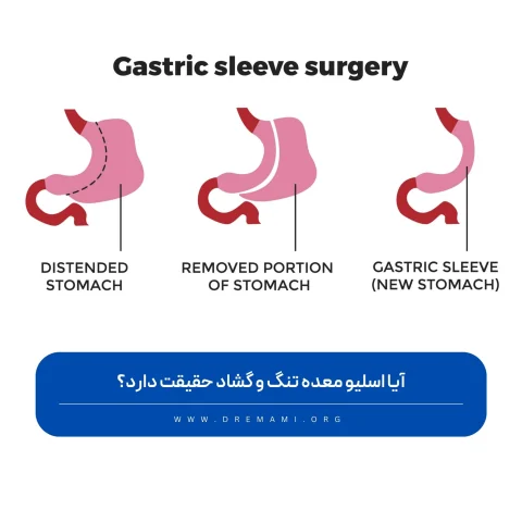 اسلیو تنگ و گشاد