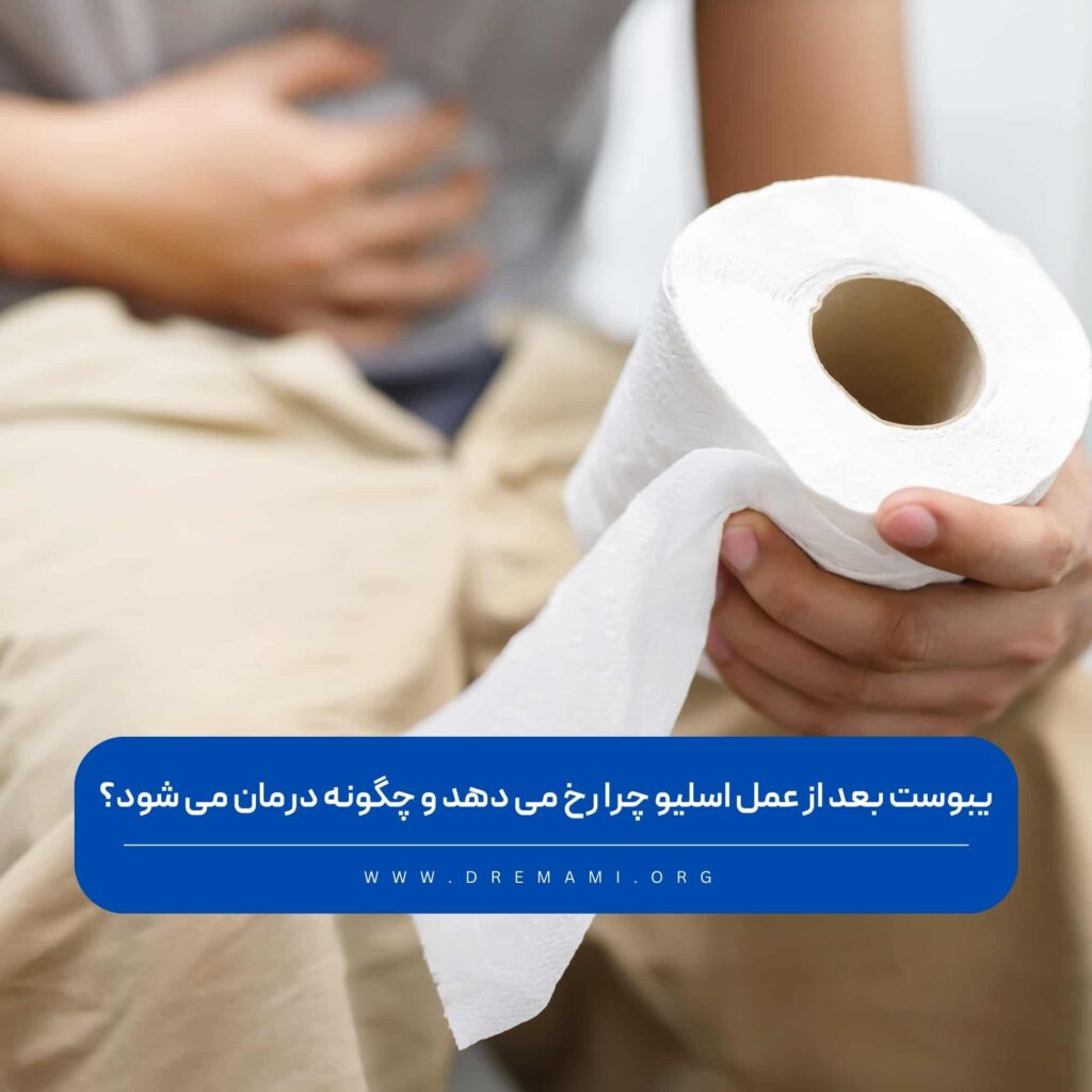 یبوست بعد از عمل سلیو معده