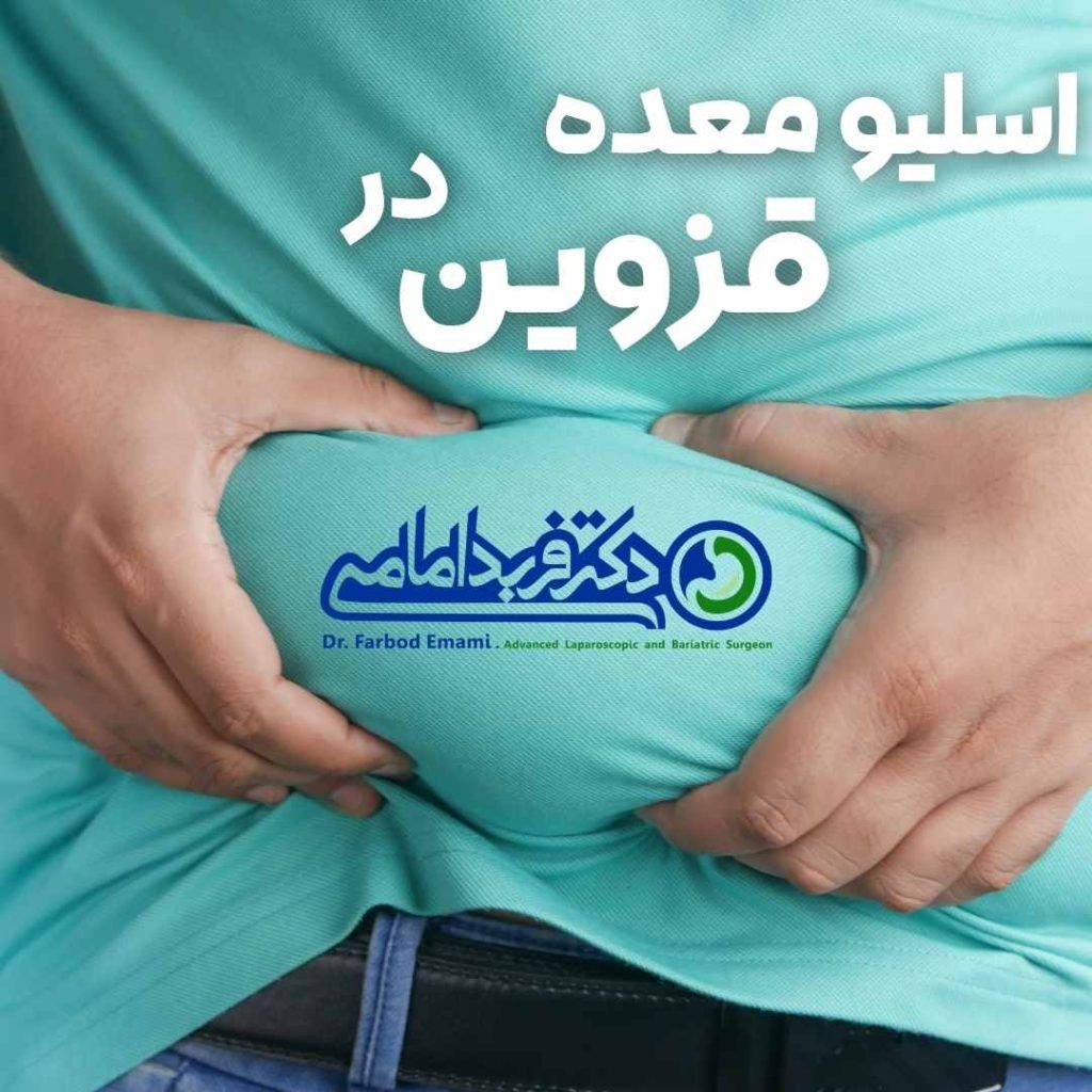 اسلیو معده در قزوین