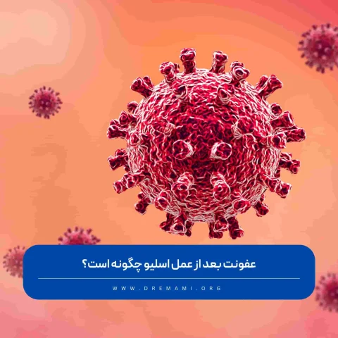 عفونت بعد از عمل اسلیو معده