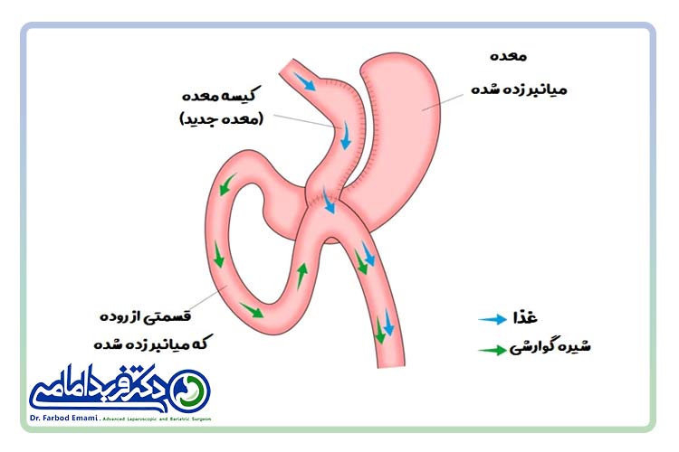 بای پس معده چیست؟