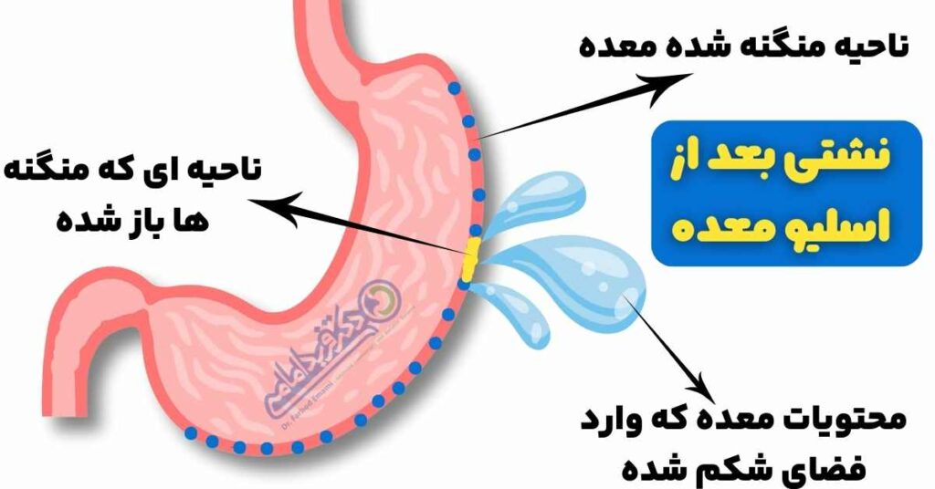 نشتی بعد از اسلیو معده چیست