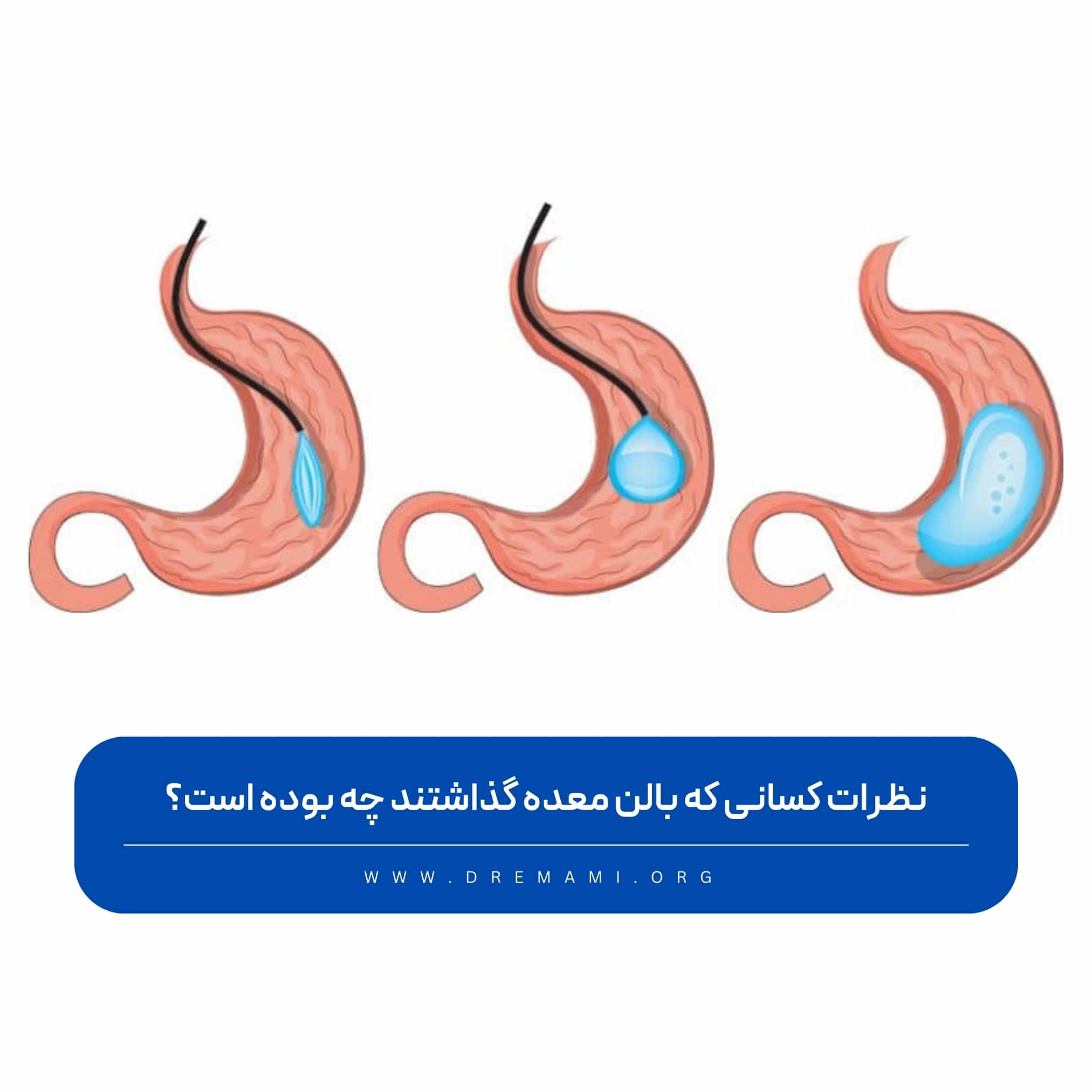 نظرات کسانی که بالن معده گذاشتند