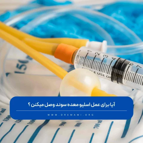 سوند برای عمل اسلیو معده