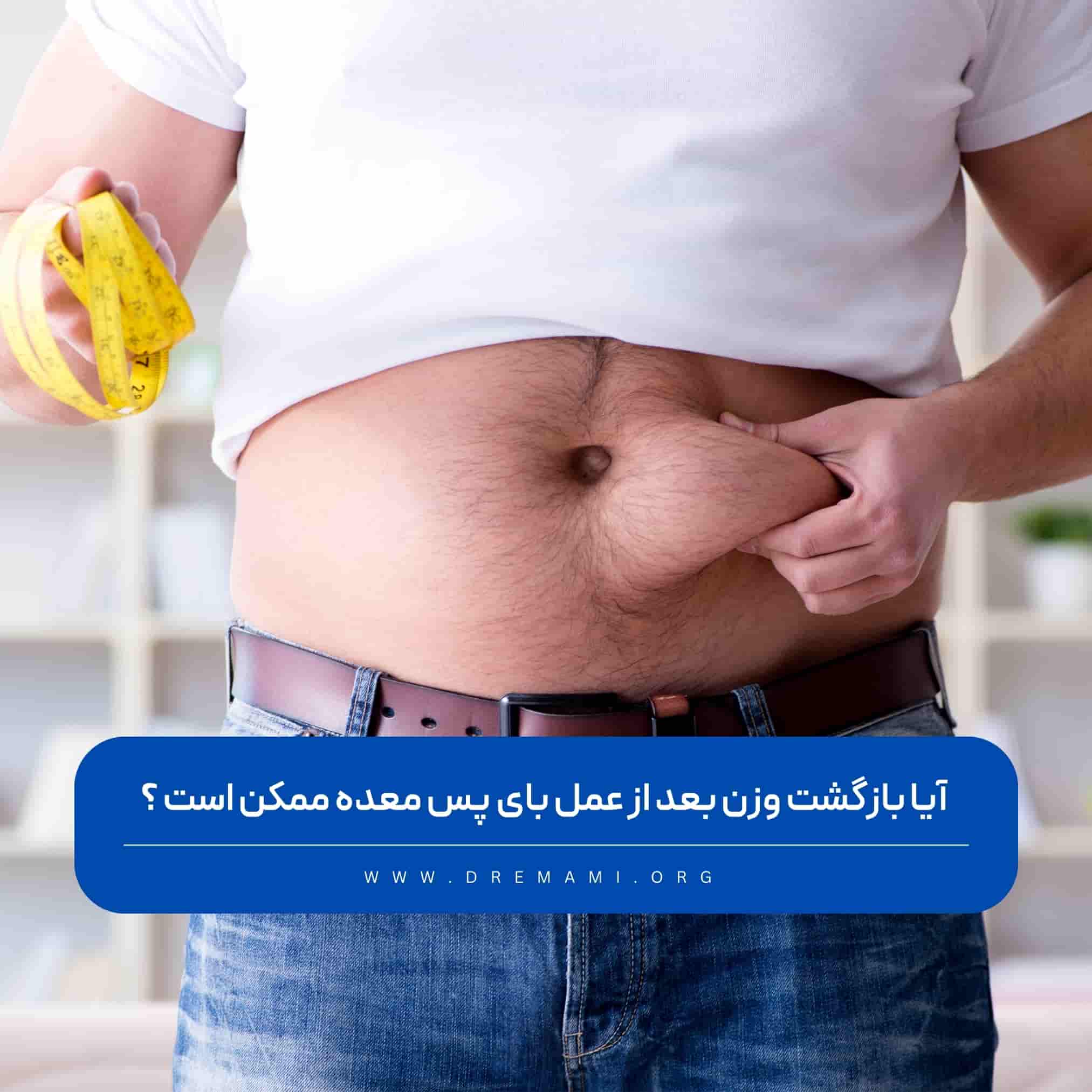 بازگشت وزن بعد از عمل بای پس معده