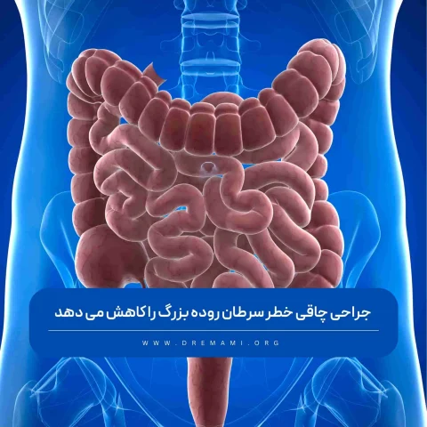 رابطه جراحی چاقی با سرطان روده بزرگ