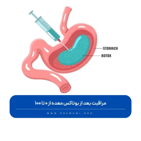 مراقبت بعد از بوتاکس معده
