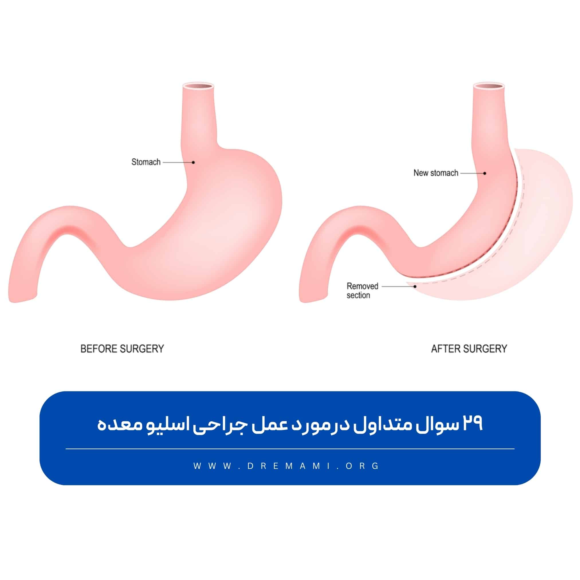 سوالات متداول در مورد عمل اسلیو معده