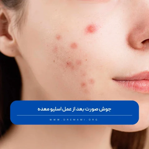 جوش صورت بعد از عمل اسلیو معده