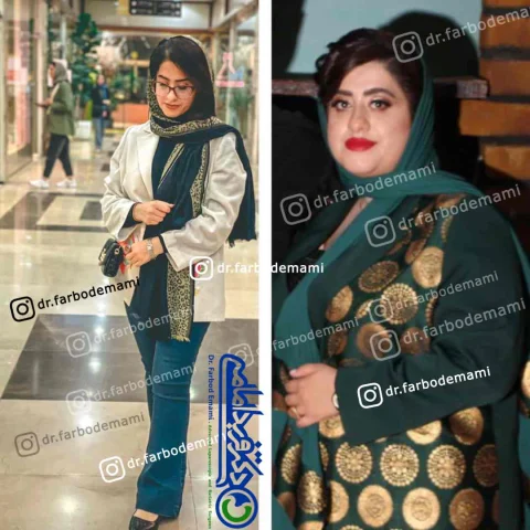 تغییرات بعد از جراحی چاقی