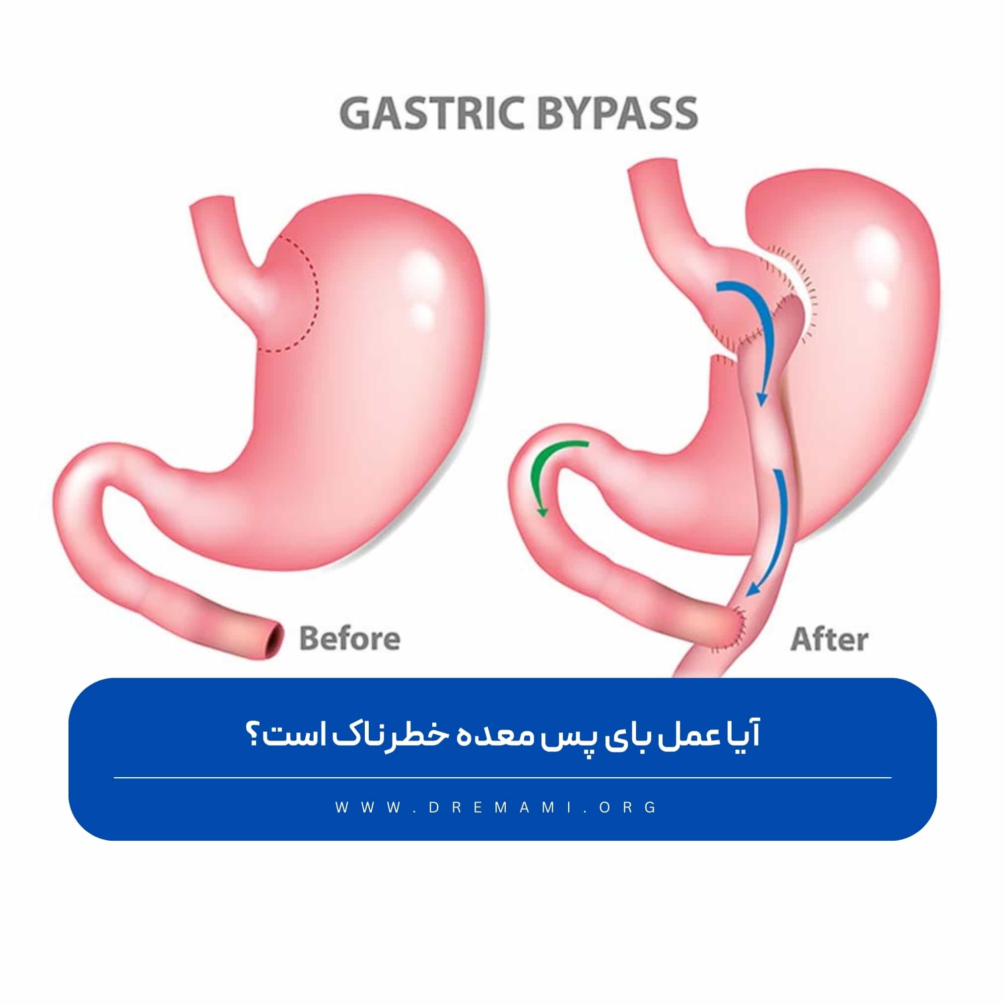 خطرات عمل بای پس معده