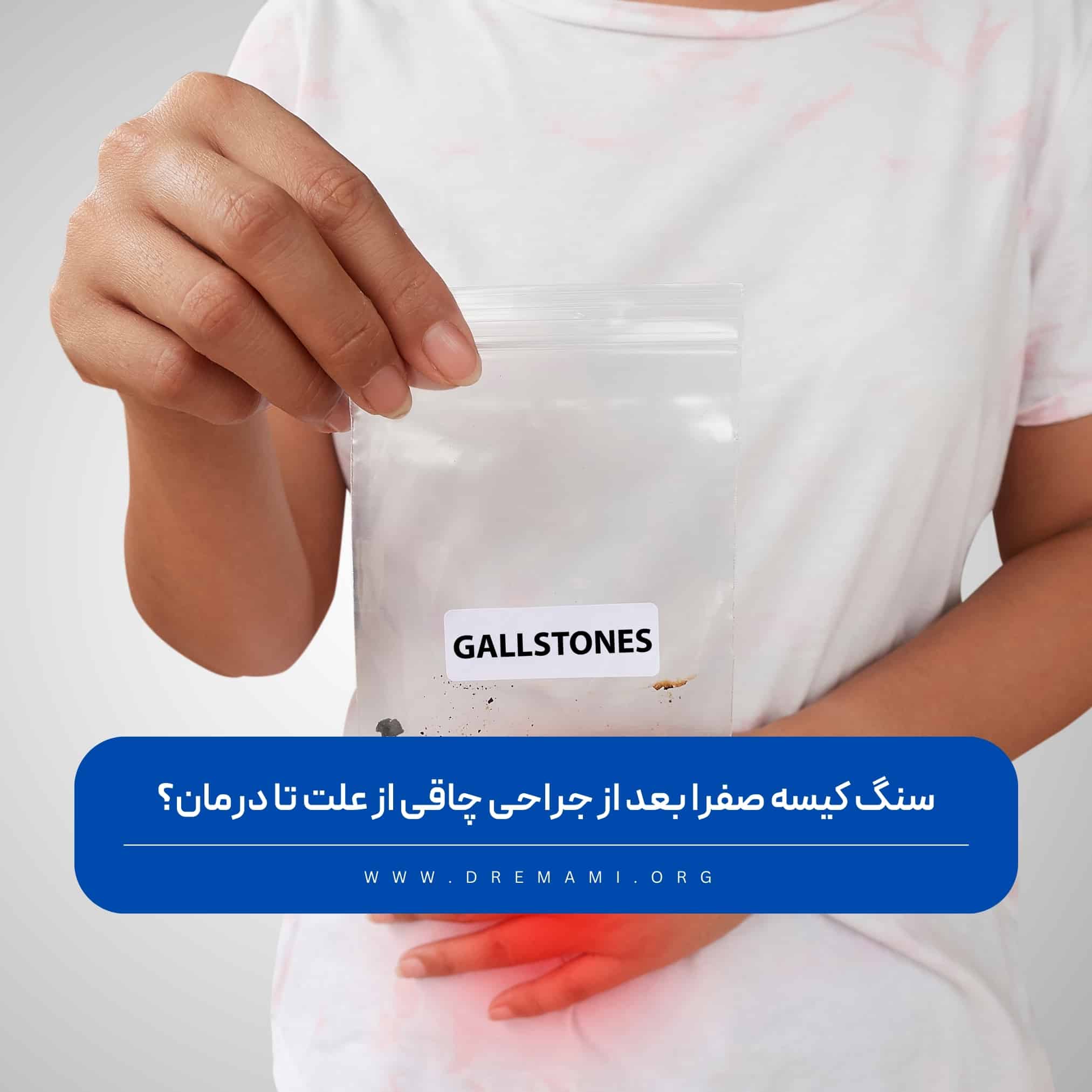 سنگ کیسه صفرا بعد از جراحی چاقی