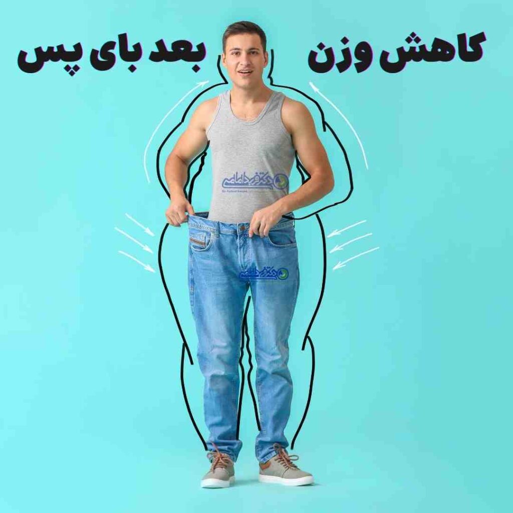 میزان کاهش وزن بعد از بای پس معده