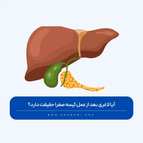 لاغری بعد از عمل کیسه صفرا