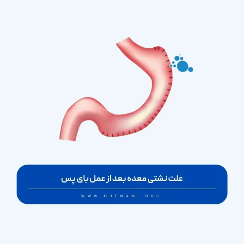 نشتی معده بعد از عمل بای پس