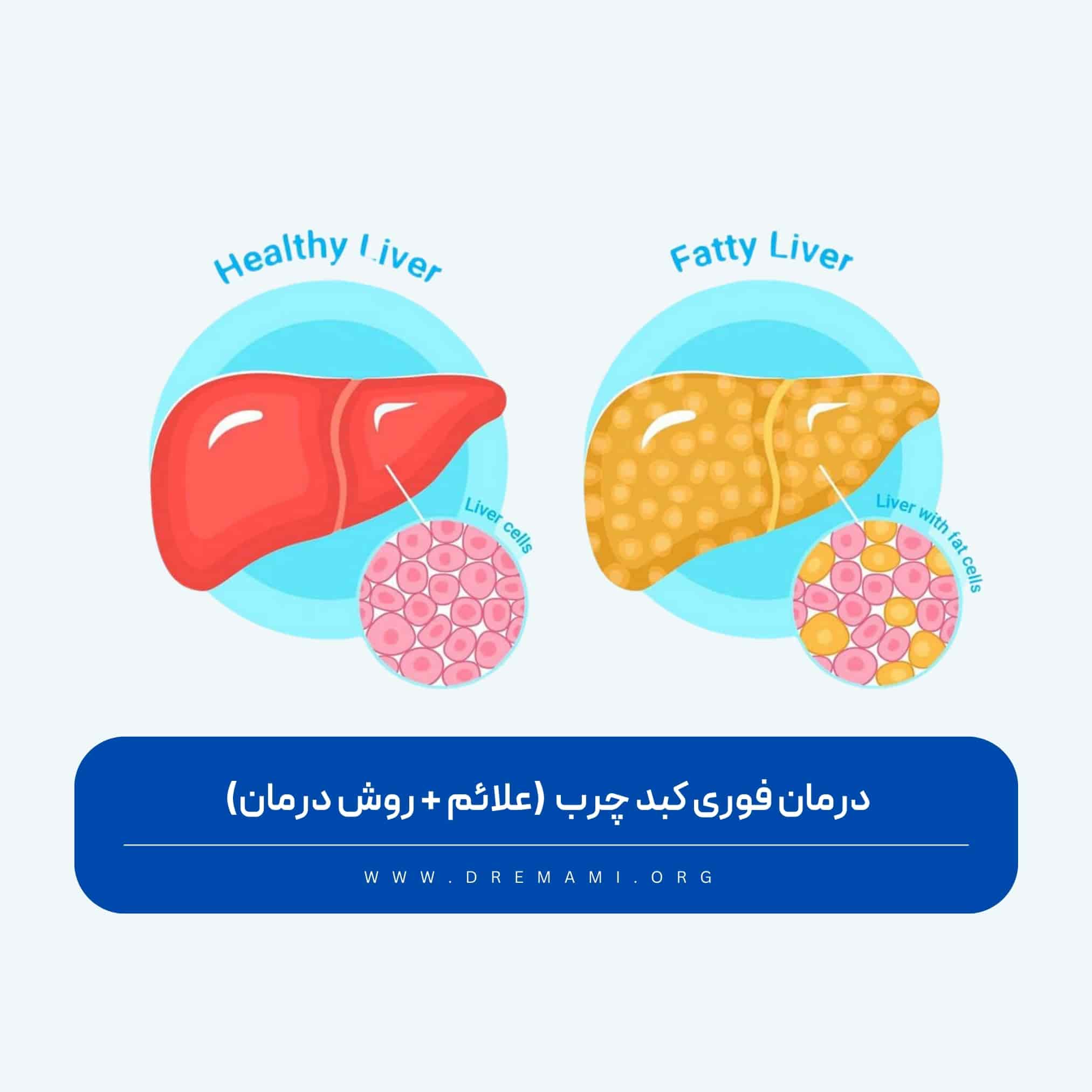 درمان فوری کبد چرب