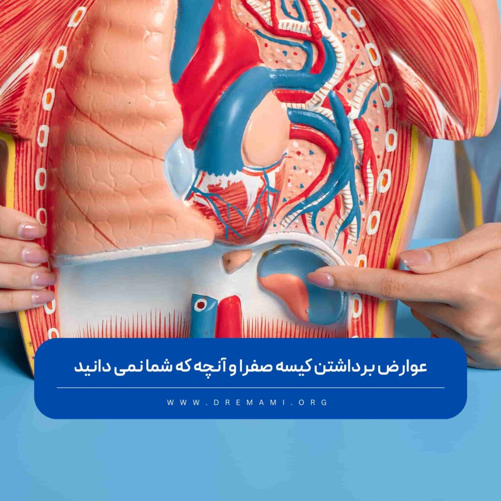 عوارض برداشتن کیسه صفرا و آنچه که شما نمی دانید