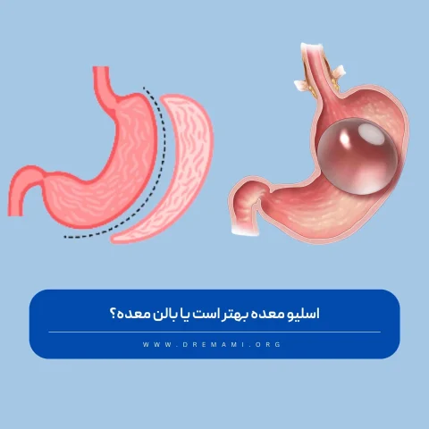 اسلیو معده بهتر است یا بالن معده