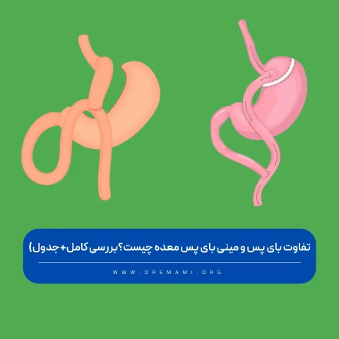 تفاوت بای پس و مینی بای پس معده