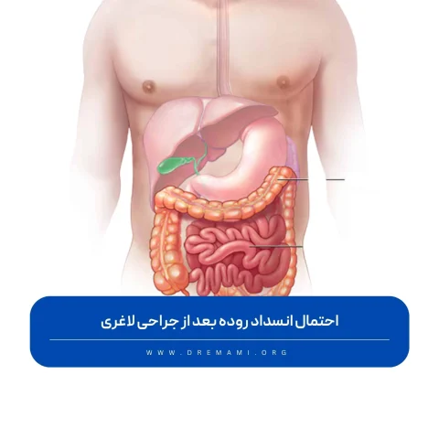 انسداد روده بعد از جراحی لاغری