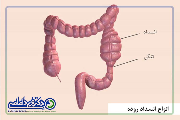 انواع انسداد روده