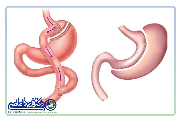 انواع جراحی لاغری