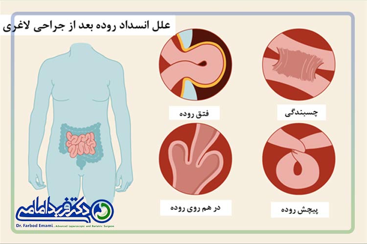 علل انسداد روده بعد از جراحی لاغری