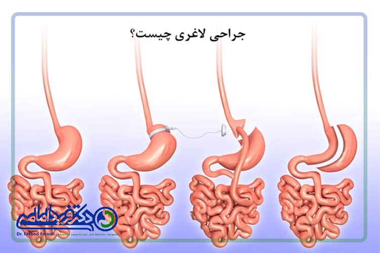 عمل جراحی لاغری چیست؟