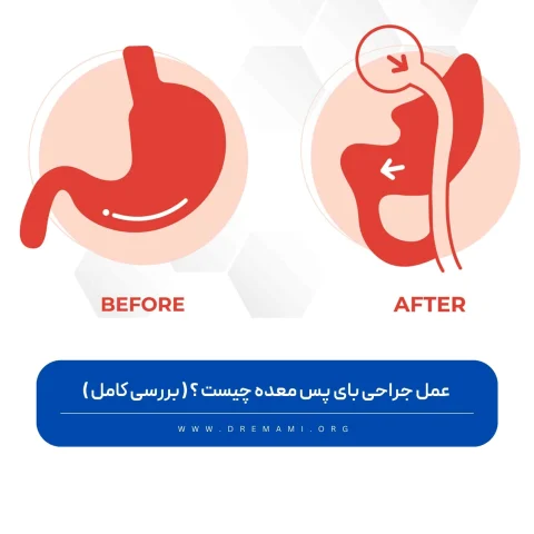 جراحی بای پس معده چیست؟