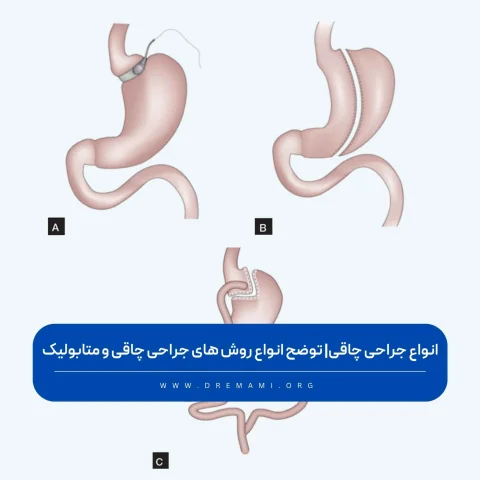 جراحی چاقی