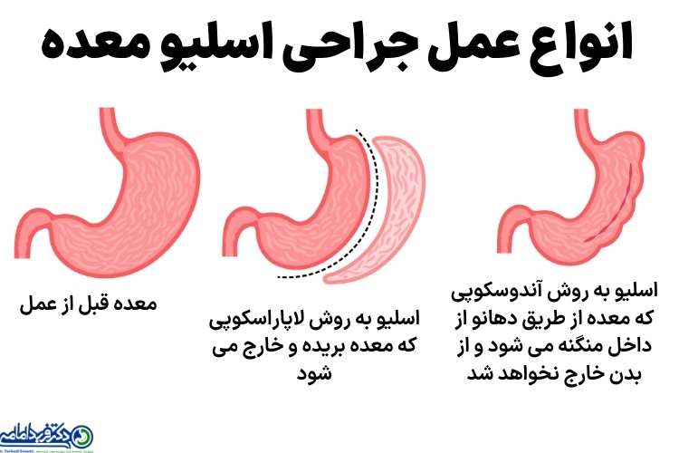 انواع عمل اسلیو معده