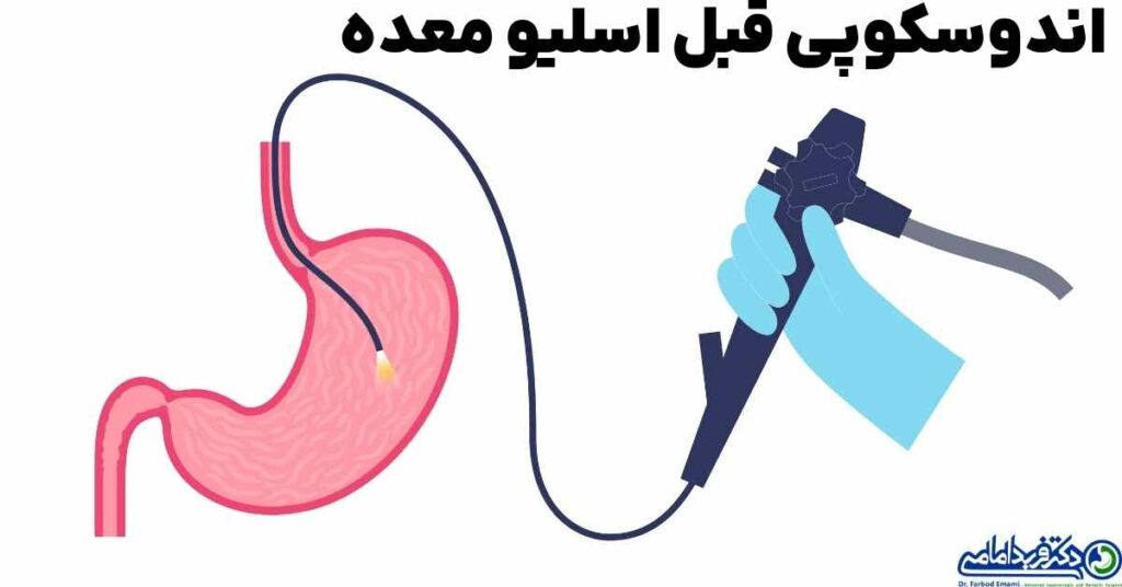 آندوسکوپی قبل از عمل اسلیو معده