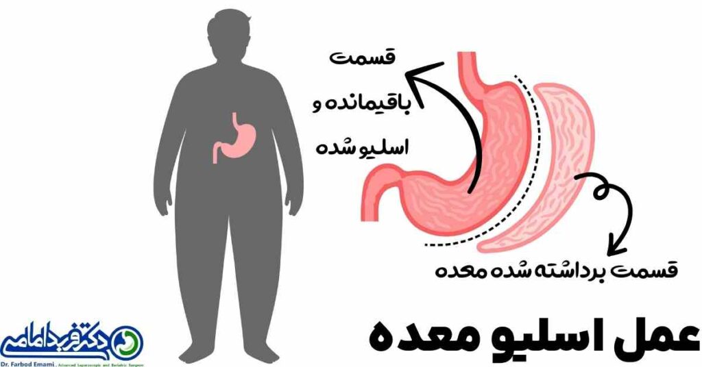 شکل عمل اسلیو معده