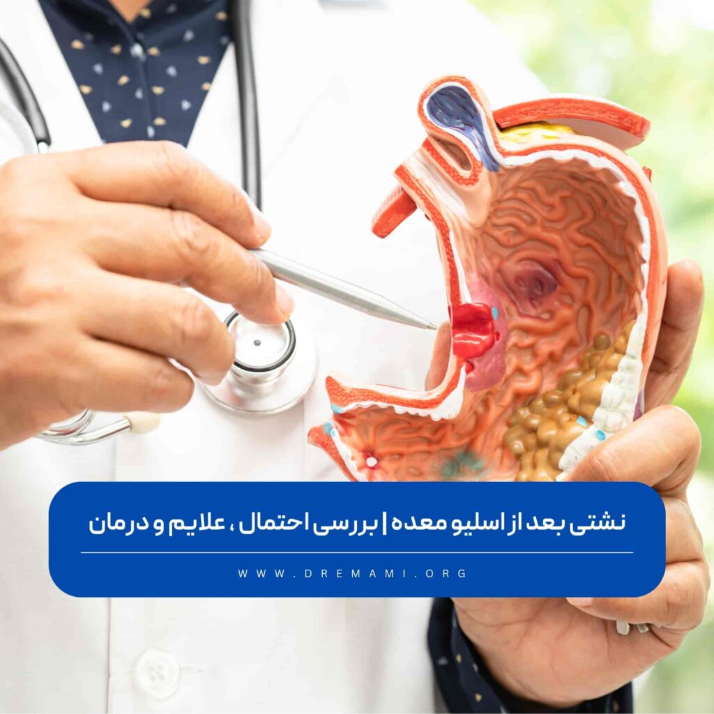 نشتی بعد از عمل اسلیو معده
