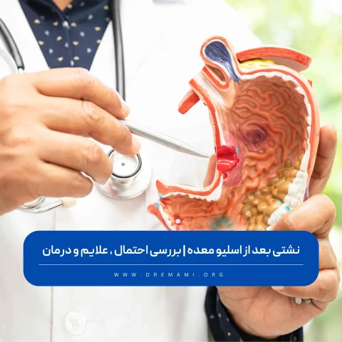 نشتی بعد از عمل اسلیو معده